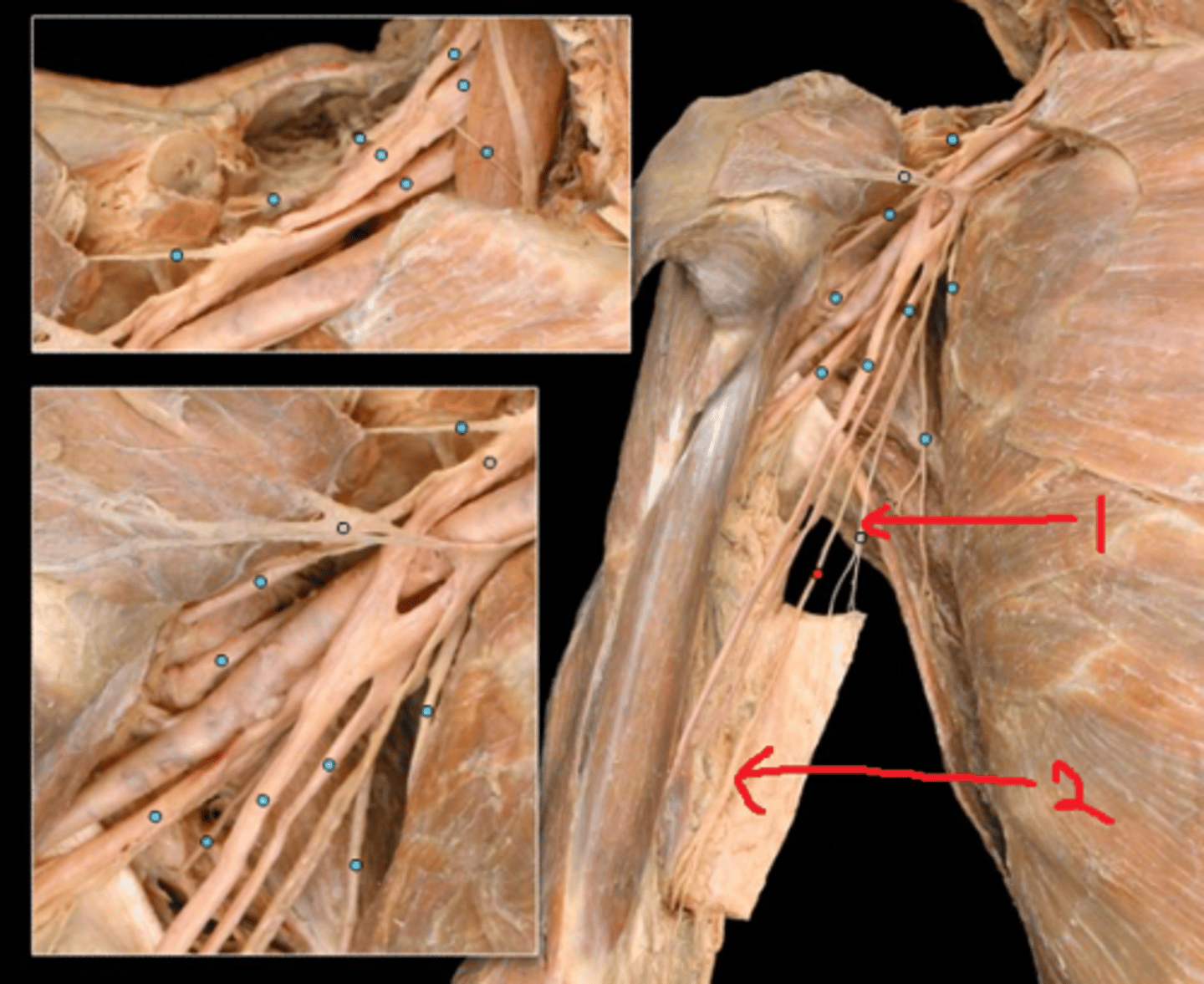 <p>inferior to the medial brachial cutaneous nerve (1)</p>
