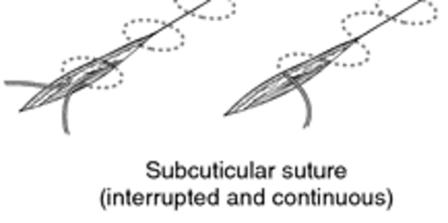 <p>Use in simple wounds that are not under tension, fast, excellent cosmetic closure ***</p><p>No stitch to remove</p><p>Doesn't hold in thin skin--- elderly..</p>