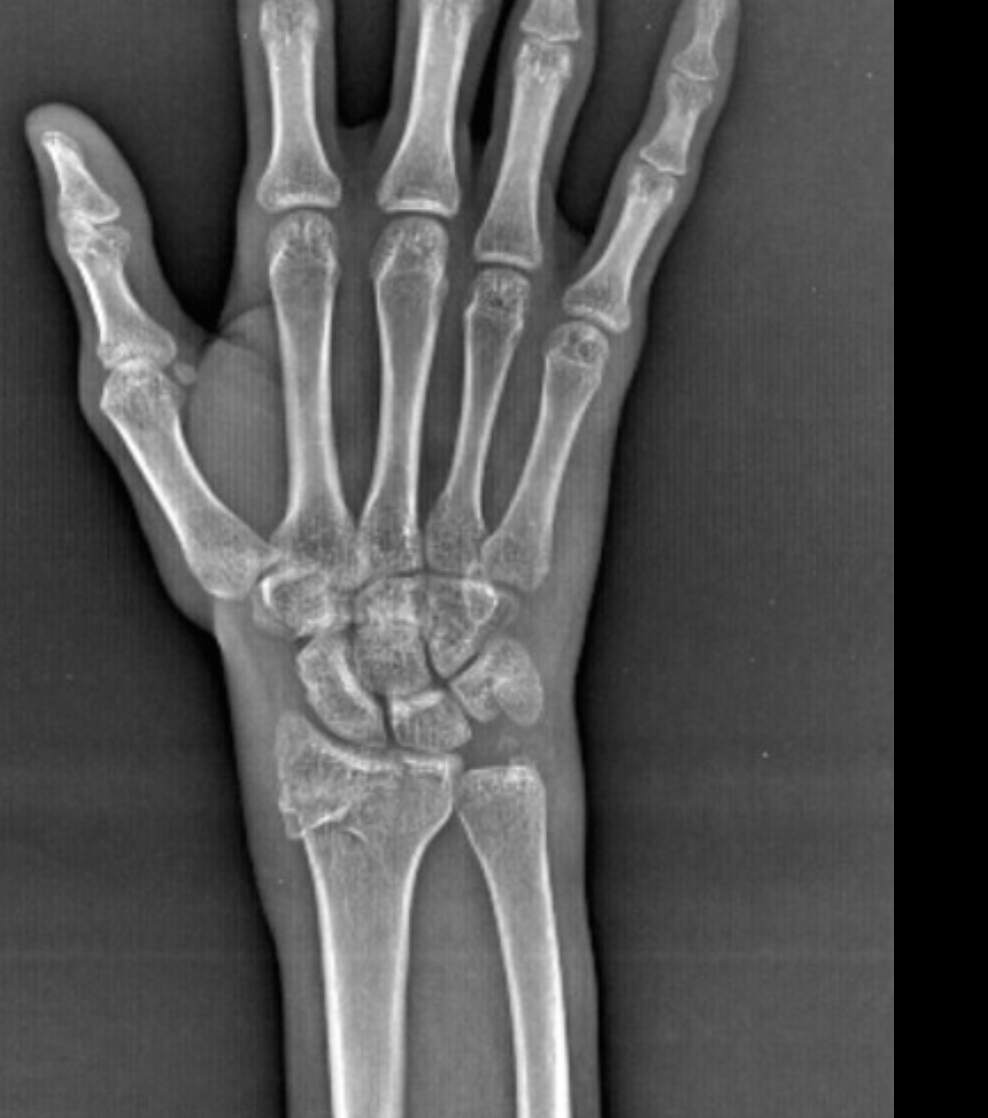 <p>A fracture-dislocation of the radiocarpal joint that is intra-articular and can be displaced dorsally or volarly</p>