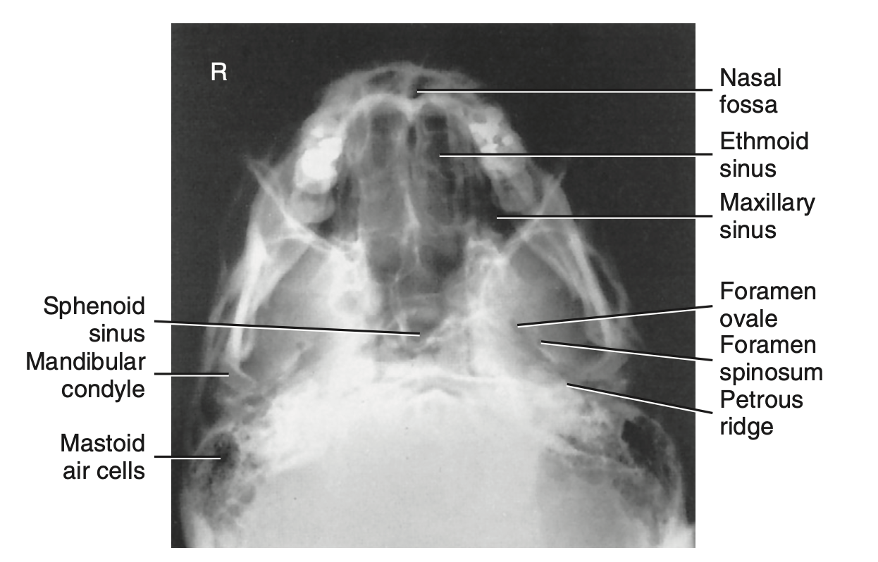 <p>Special: How do you <u>critique</u> radiograph of <strong>SMV </strong>for <strong>sinuses?</strong></p>