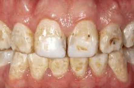 <p>Disturbances in Tooth Development: Dental Fluorosis </p>