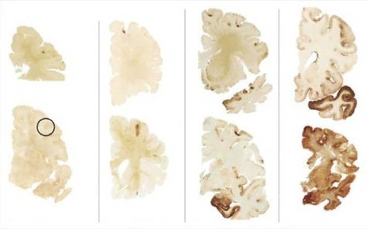 <p>A degenerative brain disease from repetitive brain trauma.</p>