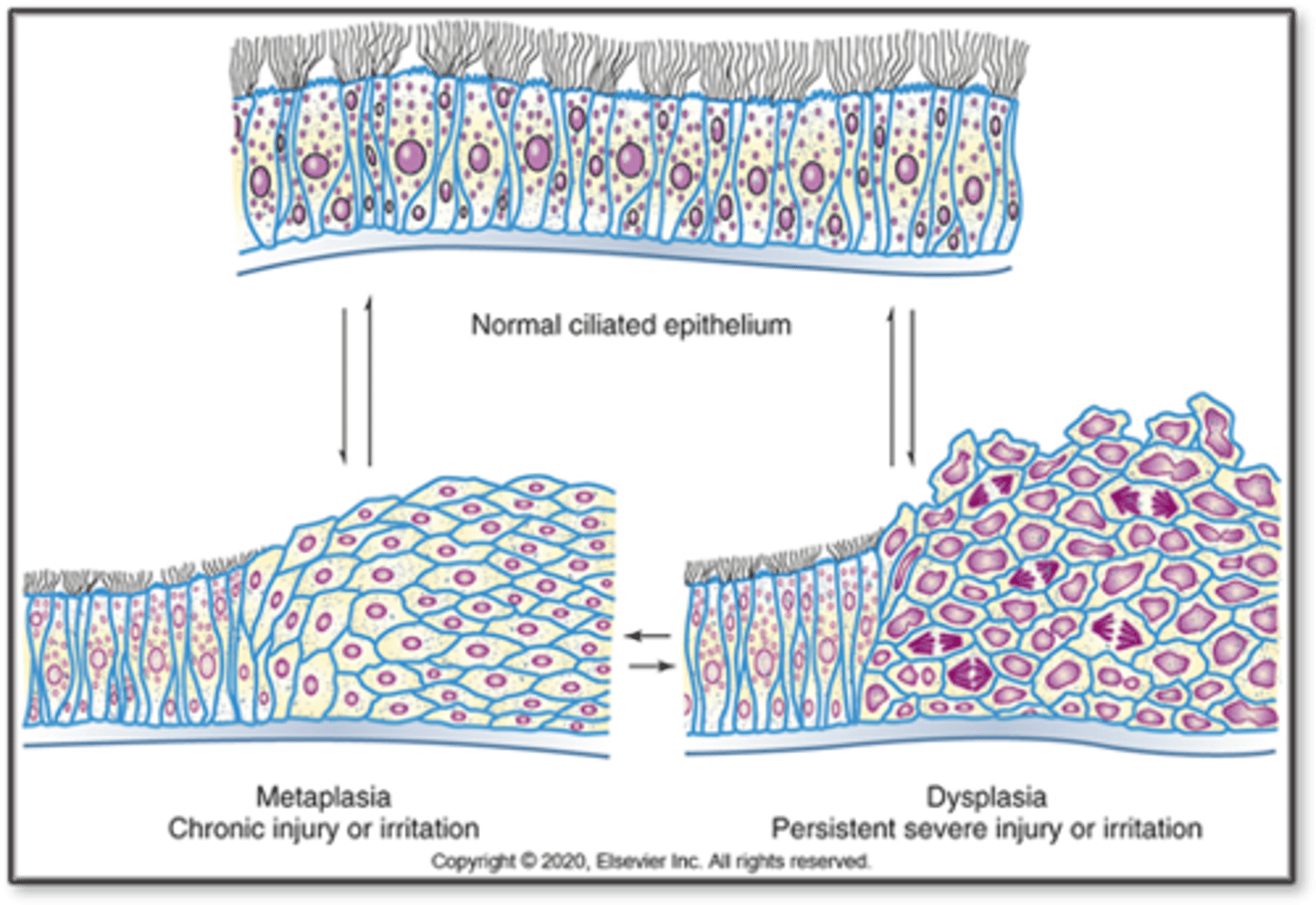 <p>- Abnormal change in size, shape, and organization of cells- Minor degrees may cause chronic irritation or inflammation</p><p>- Mostly of metaplastic squamous epithelium in respiratory tract and uterine cervix</p><p>- Potentially reversible after irritation is removed</p><p>- May/may not develop into cancer</p>