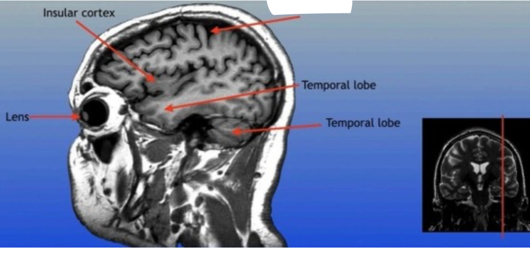 <p>A prominent groove in the brain that separates the frontal lobe from the parietal lobe, important for distinguishing motor and sensory functions. </p>