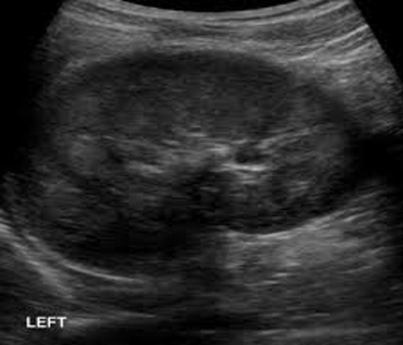 <p>glomerulonephritis; thrombosis; necrosis; hematuria</p>