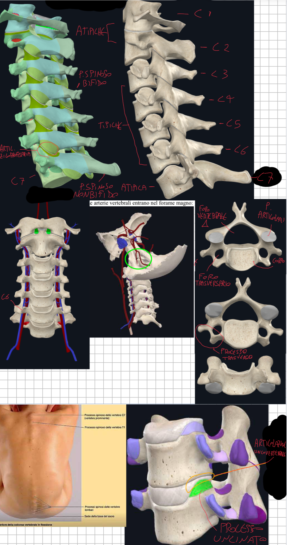 <p>Caratteristiche C3 a C6:</p><ul><li><p>Corpo Vertebrale → Piccolo con diametro trasverso maggiore dell’antero-posteriore</p></li><li><p>Processi Uncinati → sul margine superiore del corpo, che con la vertebra sovrastante forma le ARTICOLAZIONI UNCOVERTEBRALI → non del tutto chiaro il significato di questa articolazione → alcuni autori la ritengono una articolazione sinoviale che si forma dopo la nascita come risultato della degenerazione dei dischi intervertebrati tra le vertebre adiacenti che finiscono per abbracciarsi dal processo uncinato (si forma una cavità piena di liquido tra processo uncinato e vertebra sovrastante) → l’importanza clinica è nel fatto che in caso di osteofiti (esostosi, cioè piccole escrescenze ossee dovute a fenomeni degenerativi) possono comprimere l’arteria vertebrale o il nervo spinale che passano lateralmente, causando sintomi vascolari o nervosi.</p></li><li><p>Foro Vertebrale → Ampio e Triangolare</p></li><li><p>Processo Spinoso → Bifido (si ramifica sull’estremità) (più evidente nei caucasici e donne)</p></li><li><p>Processi Trasversi → presentano il Foro Trasversario attraversato dall’Arteria Vertebrale (ramo della succlavia) e Vene Vertebrali → l’arteria sale ed entra nel foro C6, mentre le vene scendono ed esce sempre da C6</p></li><li><p>Processi Articolari → quelle superiori sono speculari a quelle inferiori, così da permettere la formazione dell’articolazione zigoapofisaria tra vertebre adiacenti → nel tratto cervicale, le faccette articolari sono orientate obliquamente (quasi orizzontale).</p></li></ul><p>Differenze con C7:</p><ul><li><p>Vertebra di Transizione → caratteristiche cervicali, ma con alcuni tratti toracici come → Foro Trasversario più piccolo e Processo Spinoso più lungo e non bifido → da qui il nome Vertebra Prominente → palpabile nel 70% degli individui (nel 20% è più lungo e prominente C6, mentre nel 10% T1)</p></li></ul><p></p>