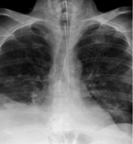<p>Aspiration, pneumothorax, esophageal perforation, hemorrhage, or death (rare).</p>