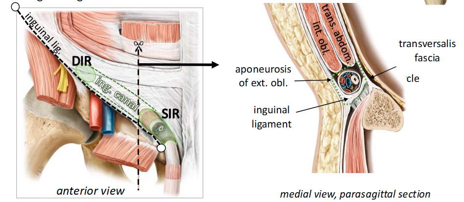 <p><span style="color: rgb(247, 245, 245);"><span>•</span></span><span style="color: transparent;"><span>•</span></span><span style="color: rgb(247, 245, 245);"><span>Anterior wall: aponeurosis of ext. oblique -&gt; superficial inguinal ring (SIR)<br>• Roof: int. oblique and trans. abdominis<br>• Posterior wall: Transversalis fascia -&gt; deep inguinal ring (DIR)<br>• Floor: Inguinal ligamen</span></span><span style="color: transparent;"><span>t</span></span></p>
