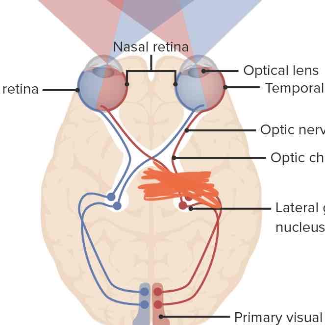 <p>What would happen if one of your optic tracts were to be destroyed?</p>