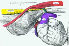 <p>Vascular ring anomaly<br />
Note: Condition is very rare</p>