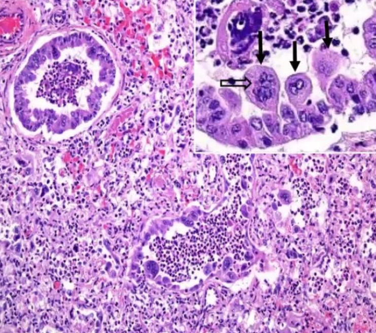 <p>What is the etiology?</p><p>A-Varicel/ovirus bovinea/pha 1</p><p>B-Bovine respiratory syncytial virus</p><p>C-Bovine astrovirus</p><p>D-Bovine pestivirus</p>