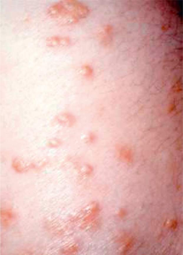 <ul><li><p><span style="font-size: inherit">lipid deposits under the skin suggests hyperlipidaemia → risk factor for <strong>ischaemic heart disease</strong> and <strong>peripheral vascular disease</strong></span></p></li><li><p><span style="font-size: inherit">typically seen over extensor tendons such as on the back of the hand (<strong>wrist</strong>) or the <strong>elbows</strong></span></p></li></ul><p></p>