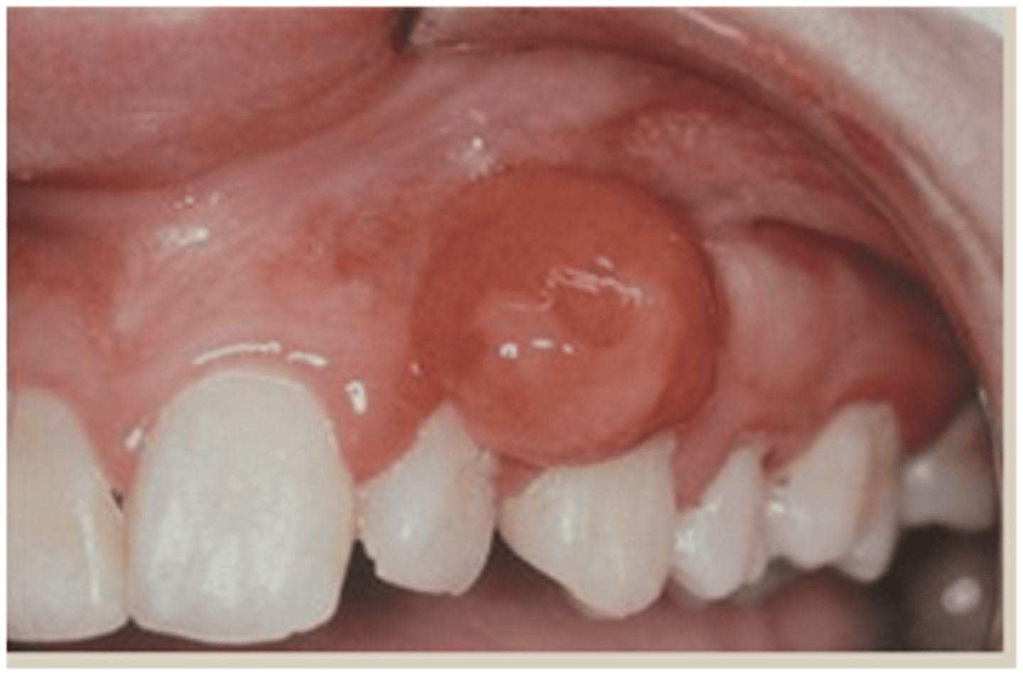 <p>• Common</p><p>• Reactive lesion caused by local</p><p>irritation or trauma</p>