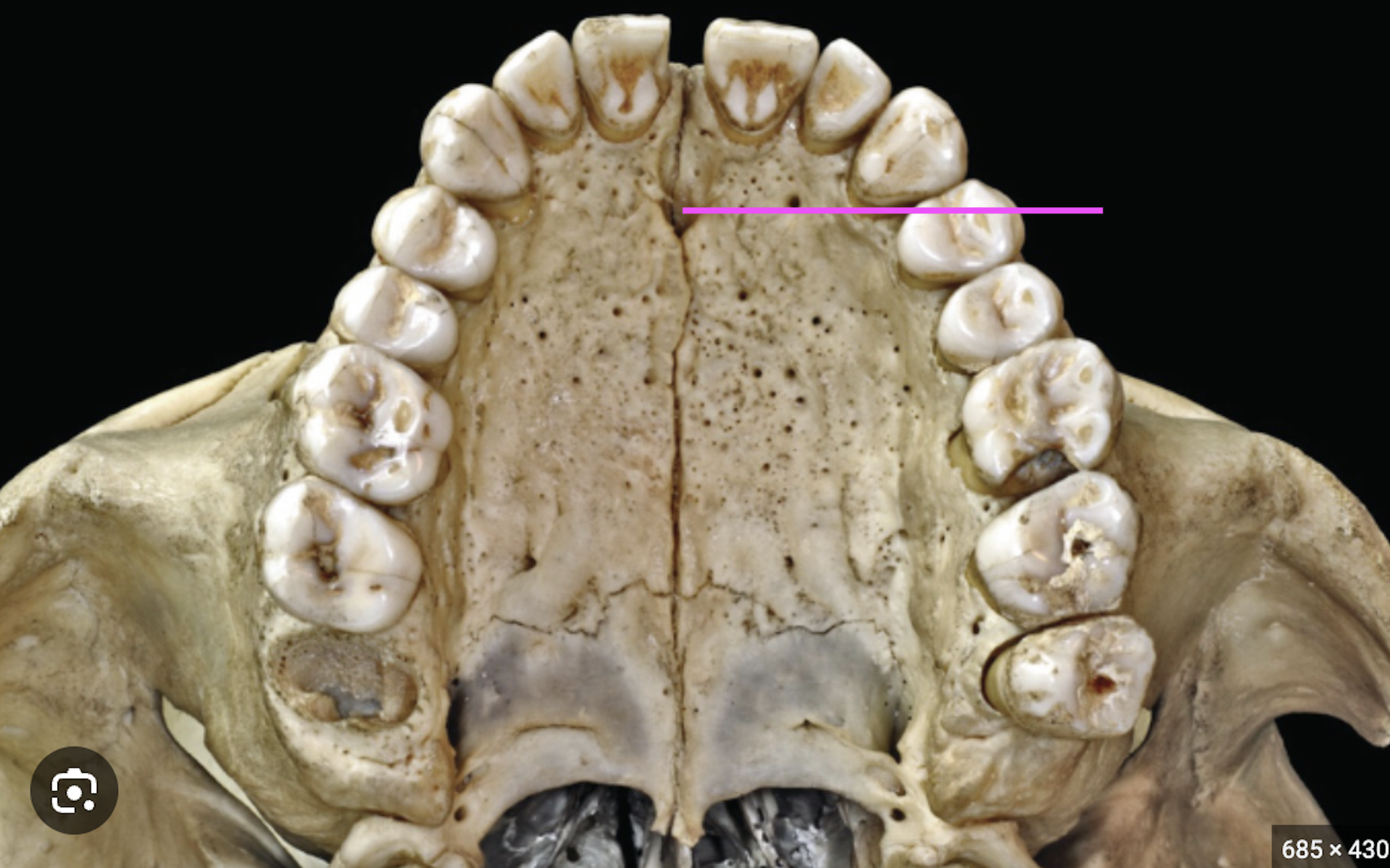 <p>What bone marking is this?</p>