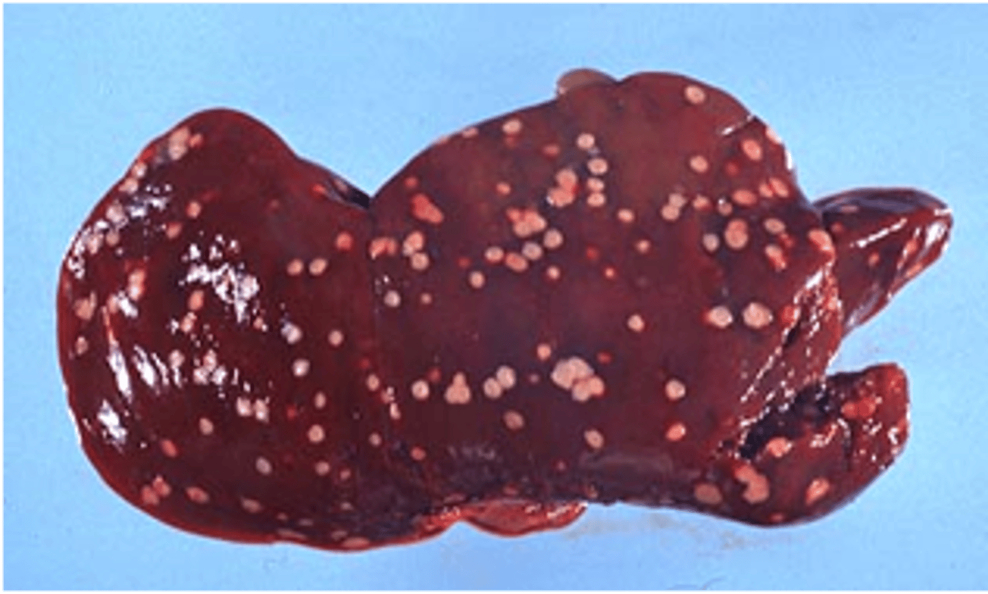 <p>the pathology of this liver indicates...</p>