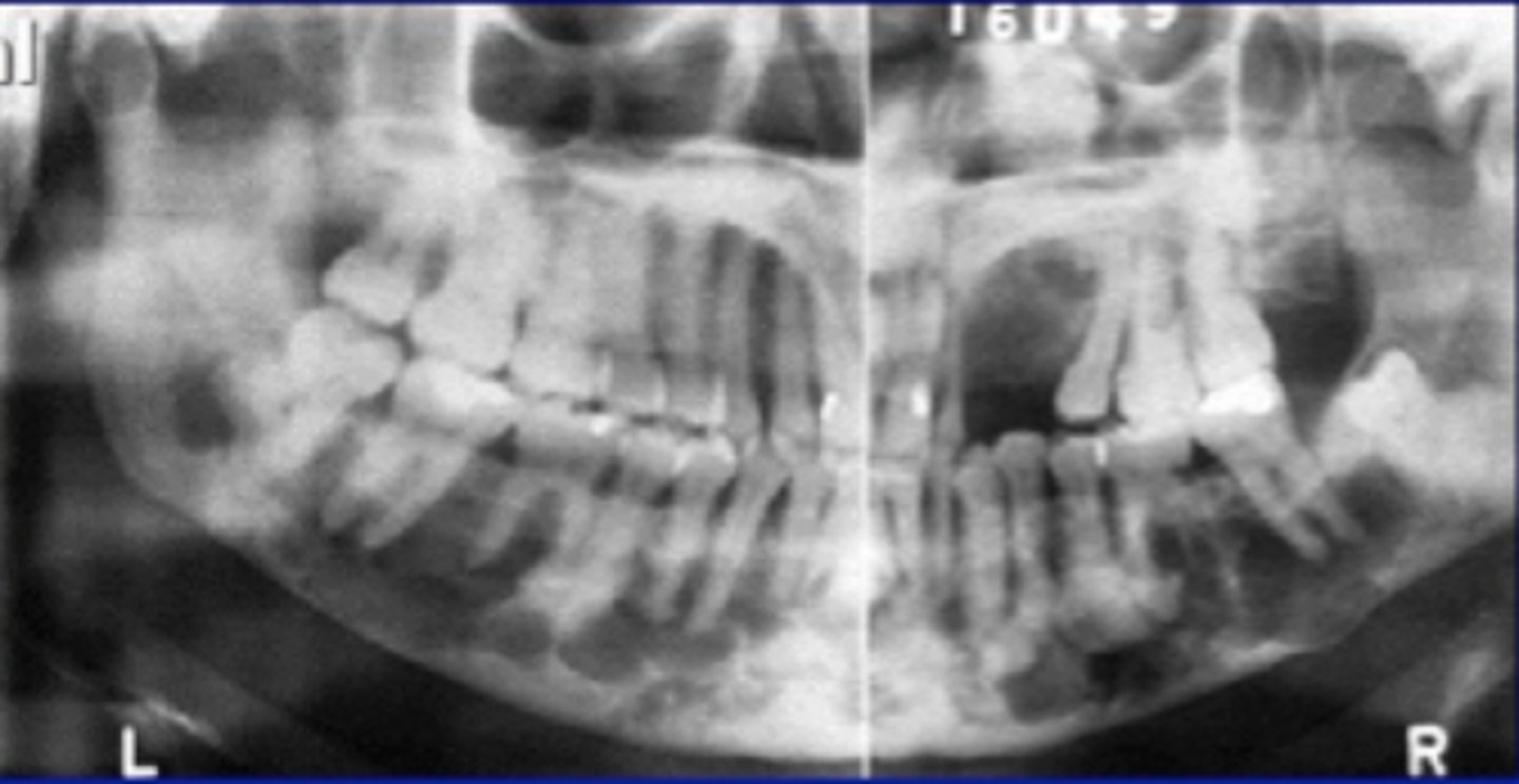 <p>widespread form of PCOD.</p><p>Normal bone replaced with dense, acellular cemento-ossoeus tissue in background of connective tissue.</p><p>poor vascular supply</p>