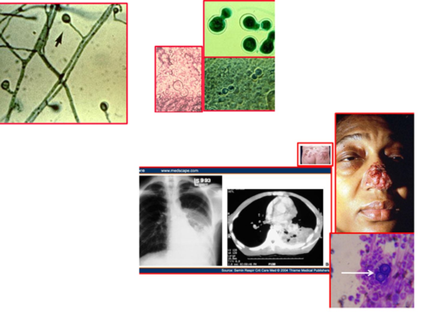 <p>Blastomycosis</p><p>- Broad-based budding from sputum confirm dx</p><p>- Itraconazole or amphotericin B</p>