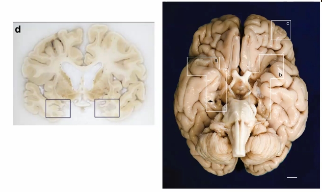 <p>The hippocampus is missing (notice the holes in his brain)</p><p>Orbital damage in part c due to lack of connection to hippocampus</p><p>Ventricles are large (white stuff in middle)</p><p>Corpus Callosum is thinned out (layer above ventricles)</p><p>Cortex is thinner than normal</p><p>Caudate looks different</p>