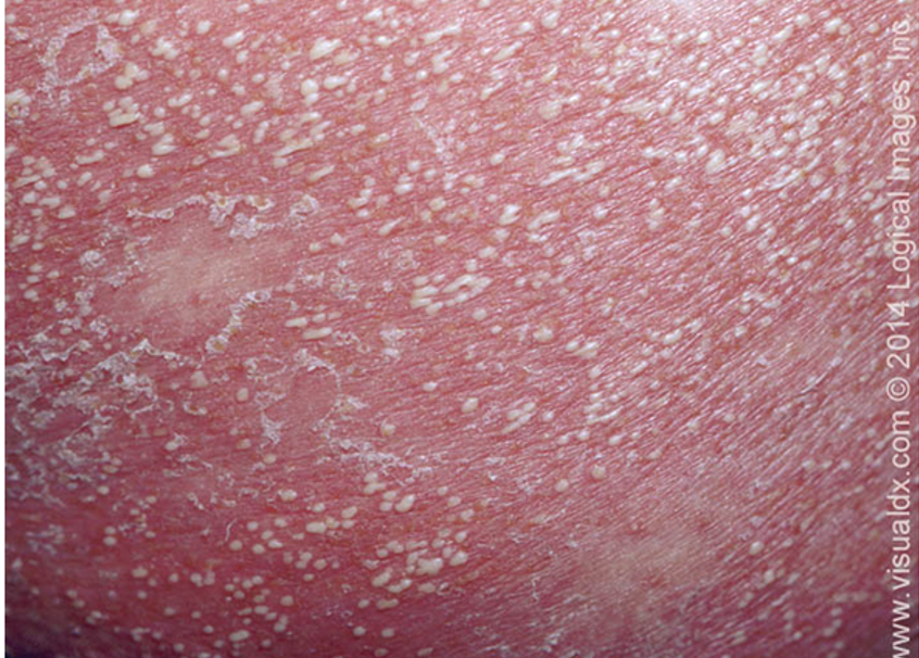 <p>what subtype of psoriasis?</p><ul><li><p>caused by pregnancy, infx, stress, withdrawal of steroids</p></li><li><p>acute onset of erythematous pustules, localized or generalized</p></li><li><p>assoc w/ malaise, fever, diarrhea, leukocytosis, hypocalcemia</p></li><li><p>can be life threatening</p></li><li><p>Von zumbusch (most severe), acrodermatitis continue of hallopeau (distal digits), palmoplantar pustulosis variants</p></li></ul><p></p>