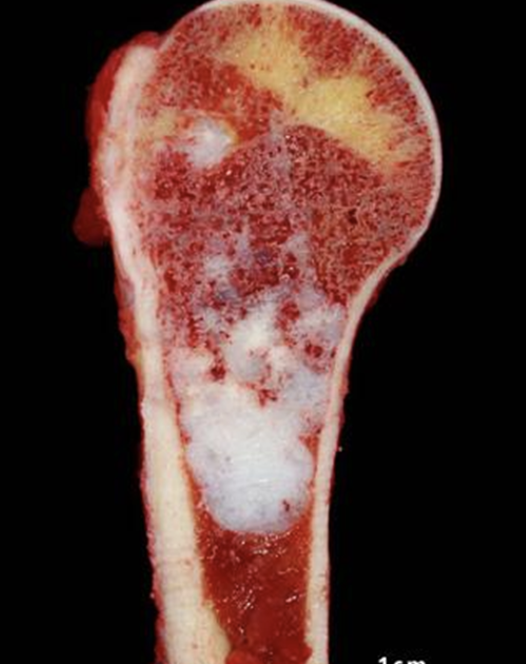 <p><span>Describe the gross appearance.</span></p><p style="text-align: left;"><span>What is the cell of origin?</span></p><p style="text-align: left;"><span>What is the diagnosis?</span></p><p style="text-align: left;"><span>What is the malignant counterpart called?</span></p>