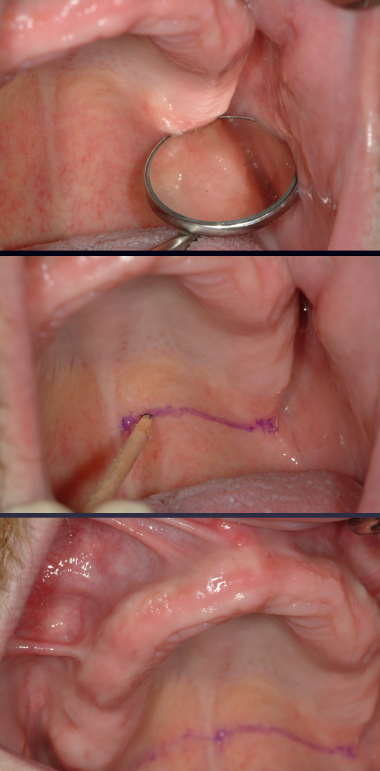 <p>Locate the hamular notch</p>