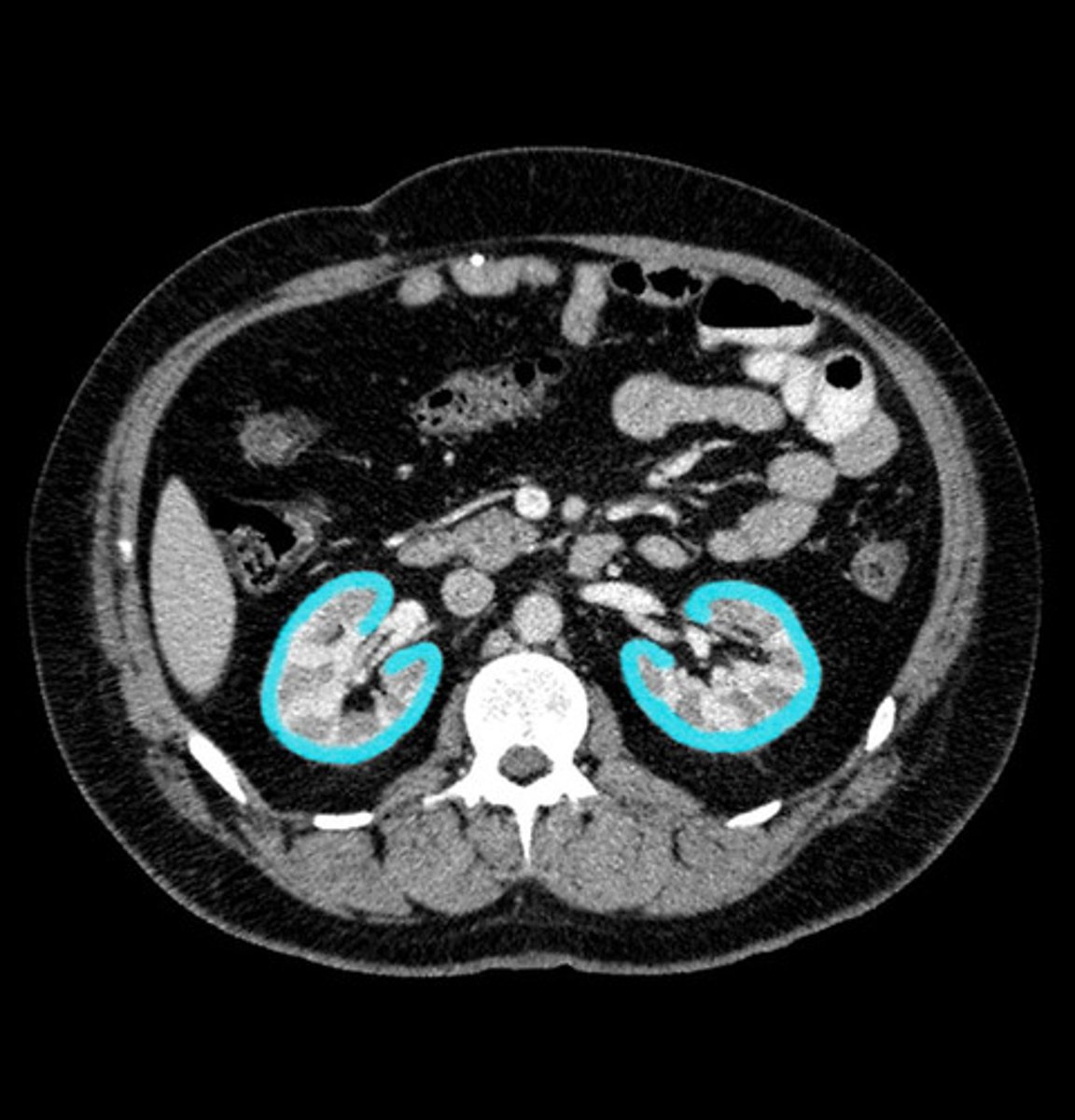 <p>xray (IV pyelography)- mainly replaced by US and CT</p><p>US- size, symmetry, lesions, kidney stones, obstructions, hydronephrosis</p><p>CT- characterize US abnormalities, study of choice for nephrolithiasis, trauma</p><p>MRI- renal cell cancer, mass</p>
