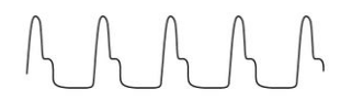 <p>= 3+ intensity; rapid systolic upstroke and then suddenly collapses</p><p><strong><u>causes:</u></strong></p><ul><li><p>aortic regurgitation</p></li><li><p>patent ductus arteriosus</p></li></ul>