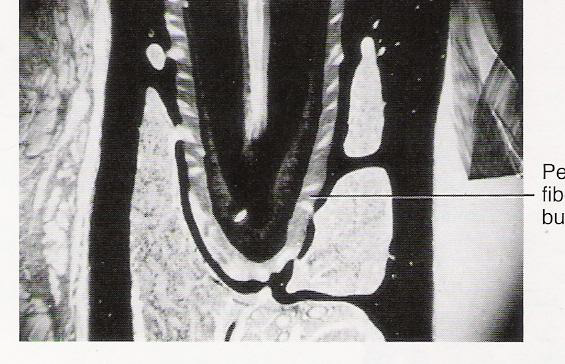 <p>Formation of apical periodontal ligament fibers and thickening and final orientation of all PDL fibers</p>