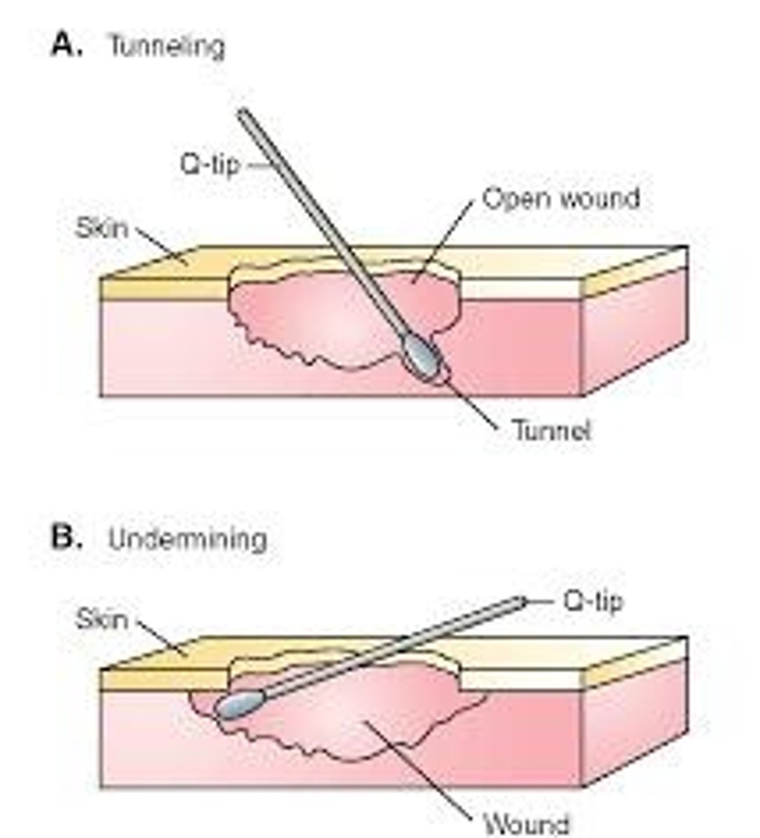 <p>A narrow passageway created by the separation or destruction of fascial planes .</p>