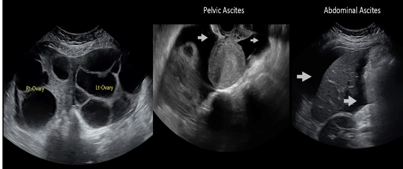<p>c) ovarian hyperstimulation syndrome </p>