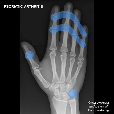 <p>PP: arthritis+psoriasis</p><p>E: distal interphalangeal joint (DIPJ)</p><p>DX:<br>Xray→“pencil in a cup” deformity</p><p>TX:<br><u>topical:</u><br><strong>1st line→topical steroids</strong><br>topical calcipotriene<br>anthralin+coal tar<br>narrow band UV x 3x/week</p><p><u>systemic:</u><br>methotrexate<br>acute→cyclosporine+taper off<br>PO acitretin<br>apremilast</p><p><u>Biologics:</u><br><strong>TNF alpha inhibitors:</strong><br>-entanercept<br>-adalimumab</p><p><strong>interleukin 12+23 inhibitor:</strong><br>-ustekinumab</p><p><strong>interleukin 17 inhibitors:</strong><br>-ixekizumab<br>-secukinumab</p><p><strong>interleukin 23 inhibitor:</strong><br>-guselkumab<br>-risankizumab<br>-tildrakizumab</p>