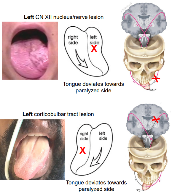 <ul><li><p>UMN lesion: Corticobulbar tract damage will lead to few symptoms due to bilateral input</p><ul><li><p>However, genioglossus (involved with protruding the tongue) has unilateral innervation</p></li><li><p>Hence, tongue deviates to paralysed side when protruded as genioglossus undergoes atrophy and flaccid paralysis</p></li></ul></li><li><p>LMN lesion: Damage results in ipsilateral atrophy, paralysis and fasciculations of all tongue muscles </p><ul><li><p>Tongue deviates to paralysed side when protruded</p></li></ul></li></ul><p></p>