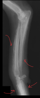 <p>Hypertrophic Osteopathy</p>