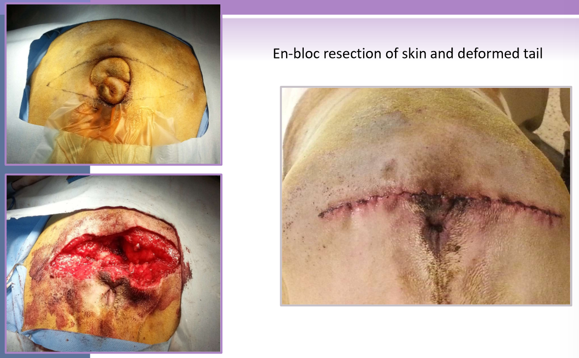 <ul><li><p>signalment </p><ul><li><p>Brachycephalic </p></li><li><p>bulldog, Schipperke, Manx cat </p></li></ul></li><li><p>screw tail, corkscrew tail, ingrown tail </p></li><li><p>redundant skin overlaps a deformed terminal caudal vertebrae </p></li><li><p>tail fold pyoderma secondary complication </p></li><li><p>en-bloc resection of skin and deformed tail </p></li></ul><p></p>