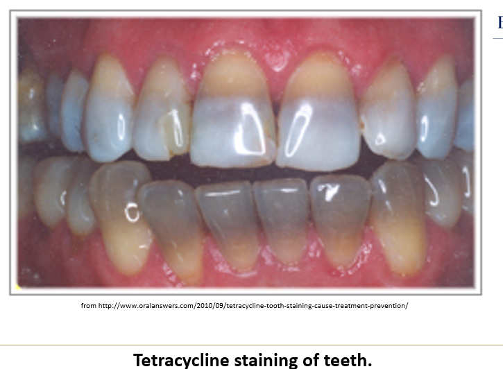 <ol><li><p class=""><strong>Tetracycline</strong> causes <strong>tooth discoloration</strong>, <strong>low enamel</strong>, and <strong>bone growth delay</strong></p></li><li><p class=""><strong>Streptomycin</strong> has been linked to <strong>8th cranial nerve damage</strong></p></li></ol><p></p>