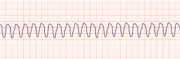 <p>Use AED, chest pain, shortness of breath, shockable rhythm)</p>