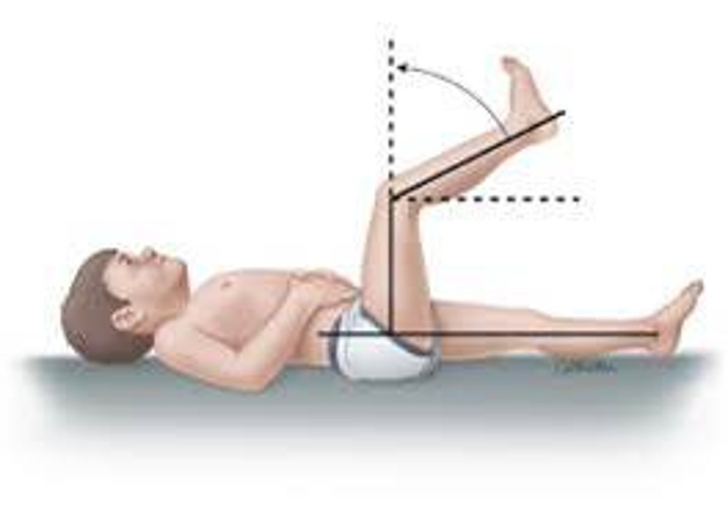 <p>fulcrum: lateral epicondyle femur<br>proximal: lateral midline femur<br>distal: lateral midline fibula<br><br>* birng hip into 90 then slowly extend knee<br>* negative = 0-31<br>* positive = >31<br><br>COMPARE TO NORMAL KNEE FLEXION (supine)</p>