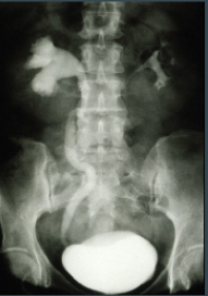 <p>Opaque medium is injected into a vein and the excretion of the kidneys can be radiographed</p><ul><li><p>Used to show renal or ureteral disease or for localization</p></li></ul><p></p><p>Has been replaced as a means of localization in RT with the use of the CT scanner which is less invasive.</p>