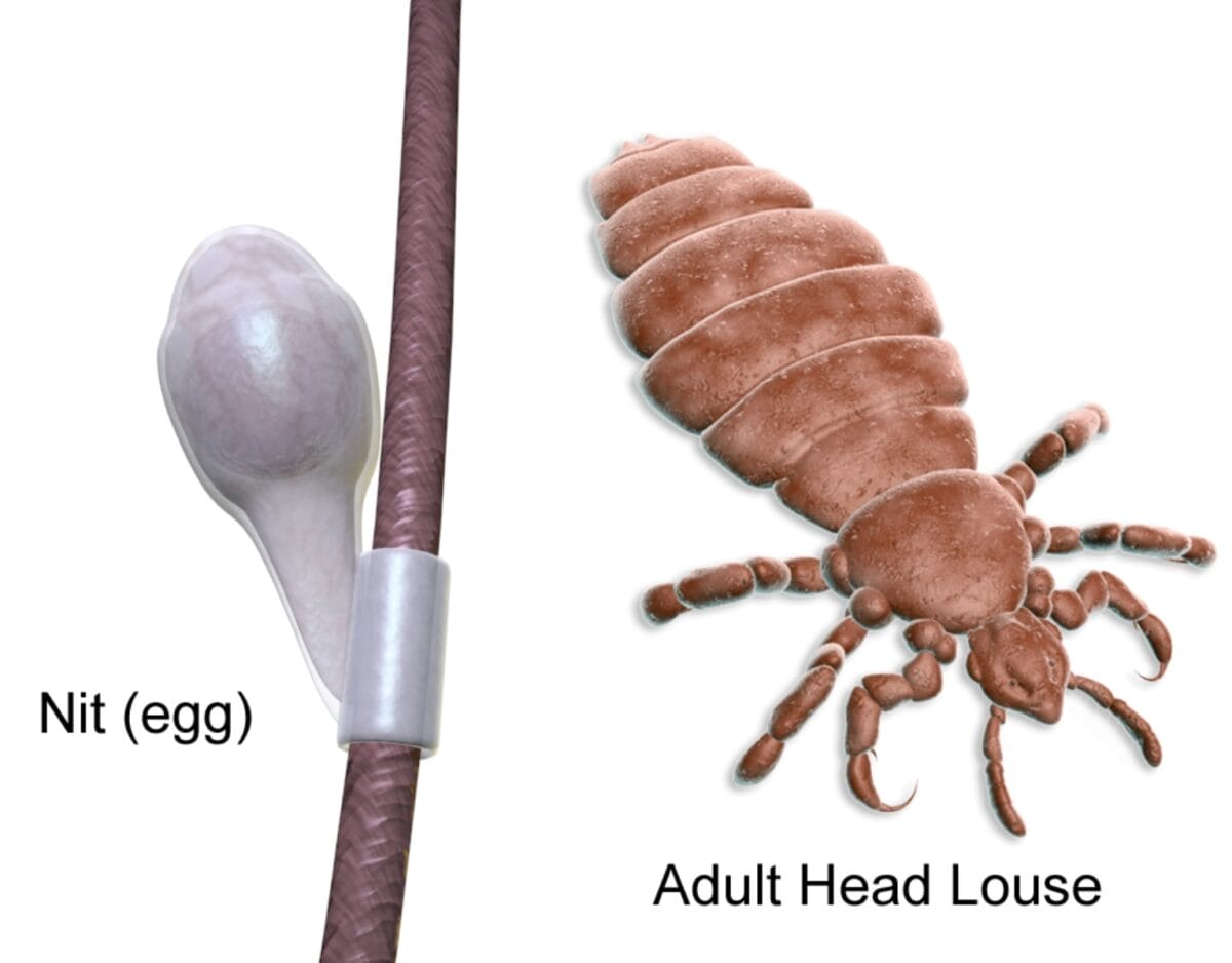 <p>PP: scalp infestation</p><p>E: head lice</p><p>CM: intense itching<br>posterior cervical lymphadenopathy<br>excoriations on scalp<br>nits/ova on hair</p><p>TX:<br>NP: remove lice+ova<br>nit combing (not on topical spinosad 0.9% suspension)</p><p>MX: permethrin<br>malathion 0.5% lotion</p>