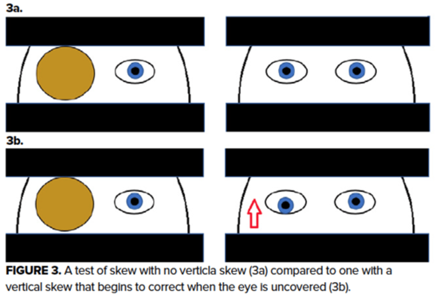 <p>alternative eye cover testing may reveal skew deviation in patients with central vertigo and should be absent in peripheral vertigo</p><p>- reassuring if no skew</p>