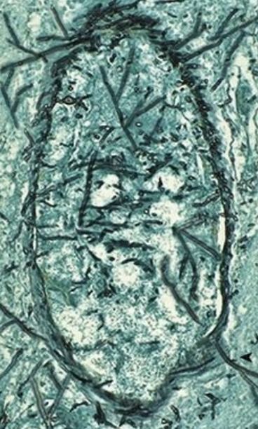 <p>8.11 Side A (PBD9: 388; BP9: 829)<br></p>
<p><br></p>
<p>Questions<br></p>
<p>A 32-year-old man with leukemia on chemotherapy develops fever, cough, and neurologic deficits. Brain CT shows hemorrhagic infarcts; vessel section GMS stain shown.<br></p>
<p><br></p>
<p>1. What infection does he have?<br></p>
<p>2. What immune defect is present?<br></p>
<p>3. Where did the infection start?<br></p>