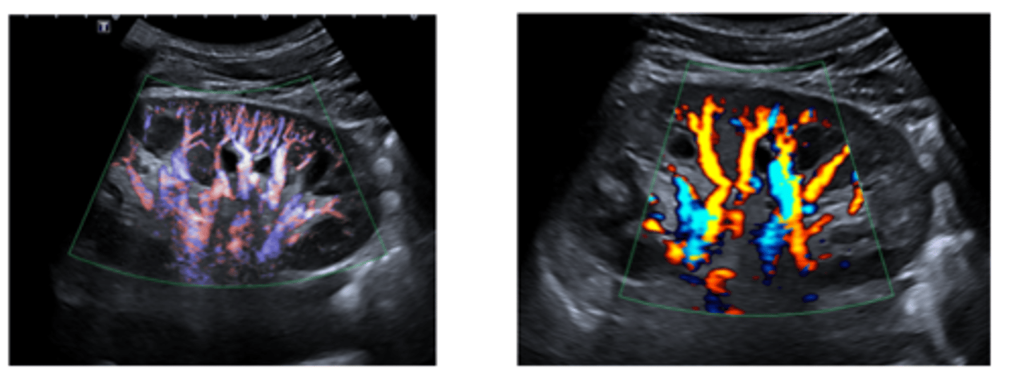 <p>Dirección del flujo sanguíneo.</p><p>Estenosis arterial o problemas de perfusión.</p>