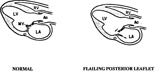 <p>Tip of the MVL points into the LA in systole and in LV in diastole. There is also coarse disorganized flutter of the flail leaflet throughout systole and diastole.</p>