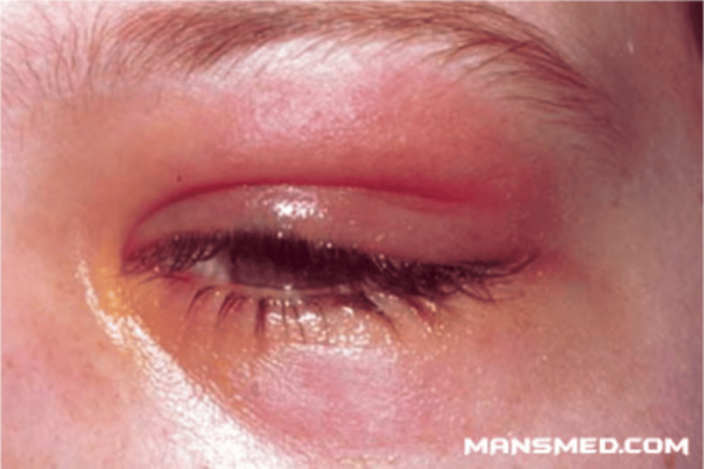 <p>Dacryoadenitis</p>