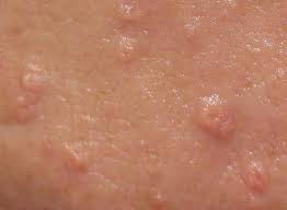 <p>raised yellow papules</p>