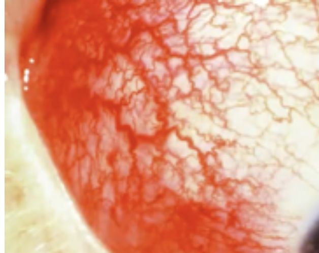 <p>Abnormalities of the External Eye</p><ul><li><p>Inflammation of the sclera</p></li></ul><p></p>