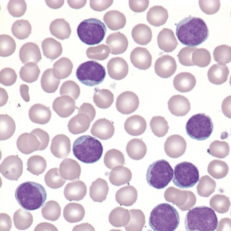 <p>which mature lymphoid neoplasm is associated with the following characteristics:</p><ul><li><p>medium to large lymphs with ample cytoplasm</p></li><li><p>more open chromatin</p></li><li><p>prominent nucleolus </p></li></ul><p></p>