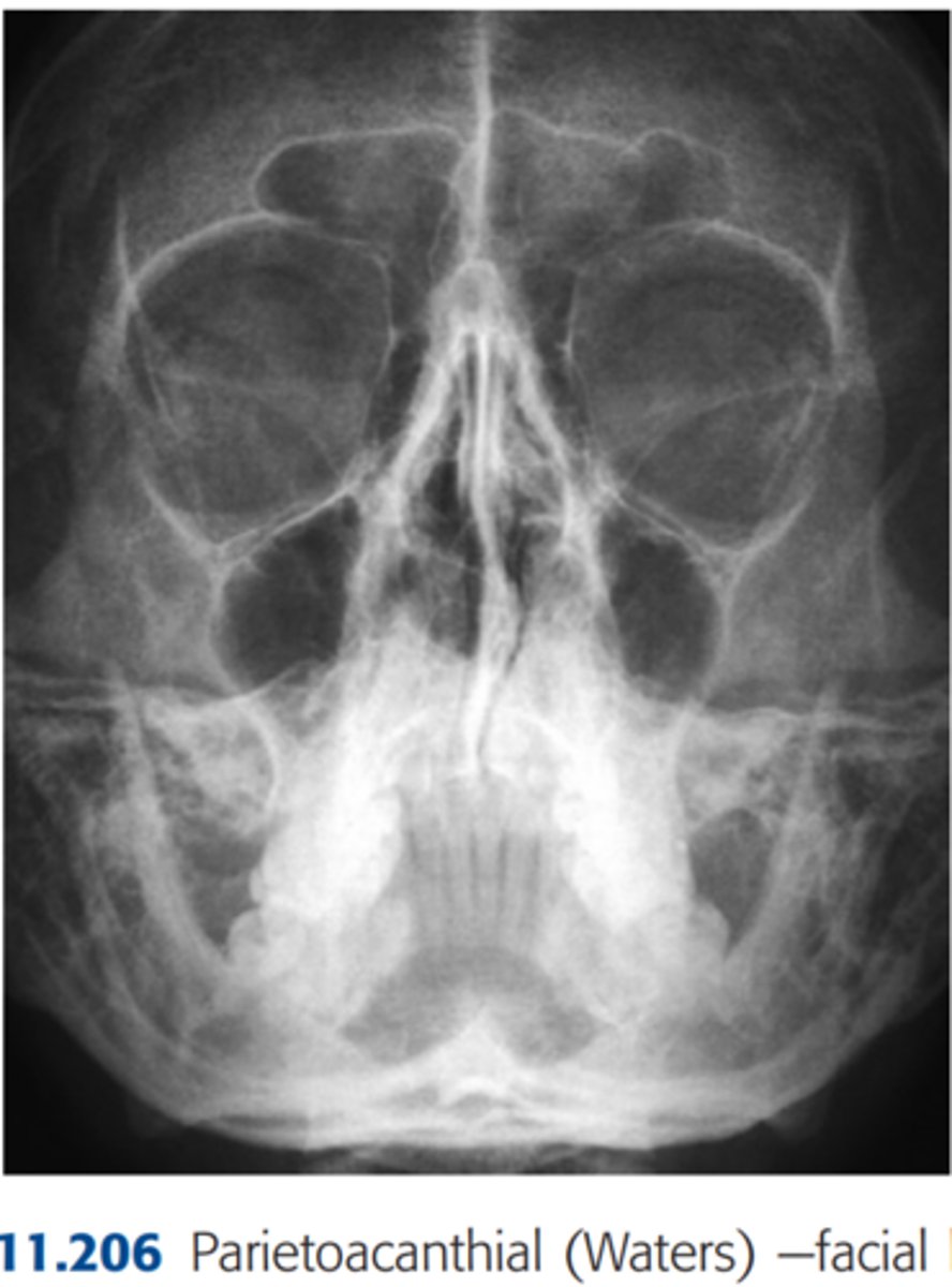 <p>Repeatable errors (three)—</p><p>Criterion 2: Positioning: Skull and neck are underextended, as evidenced by projection of petrous ridges into lower portion of maxillary sinuses. There is a slight tilt to the left. </p><p>Possibly Criterion 3: Collimation and CR: Collimation can be increased to minimize exposure to skull and neck region. CR is centered slightly too high.</p>