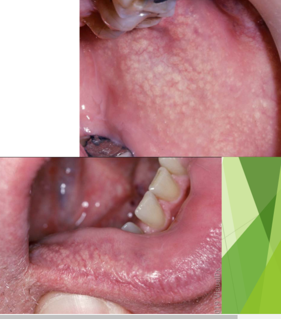 <p>fordyce spots characteristics</p>