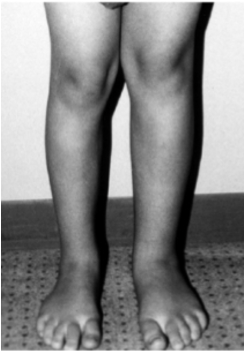 <p>A 3-year-old girl is evaluated for developmental delay and seizures. On exam, she has hemihypertrophy of the right arm and leg, macroglossia, and a firm left-sided abdominal mass. Ultrasound confirms a large renal tumor. Genetic testing shows chromosomal abnormalities. Which of the following syndromes is most consistent with her presentation?</p>